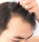 Rambut Kepala Belakang Gatal